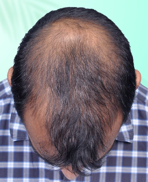 PRP Therapy in Delhi, PRP Treatment for Hair Loss in Dwarka, Delhi